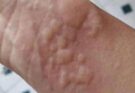 Ignoring Sudden Skin Reactions Can Lead To Very Serious Health Emergencies